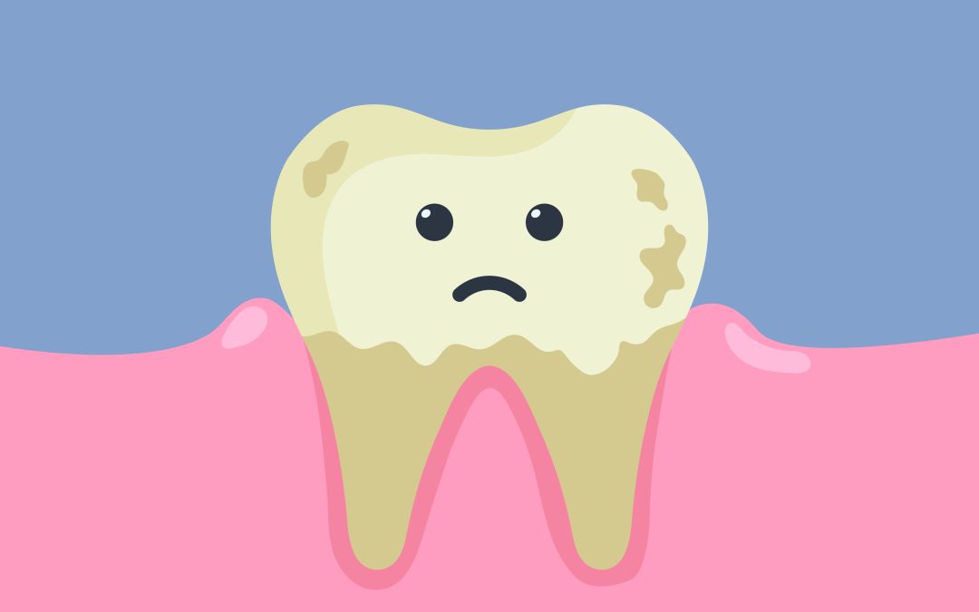 5 Common Causes of Tooth Discoloration