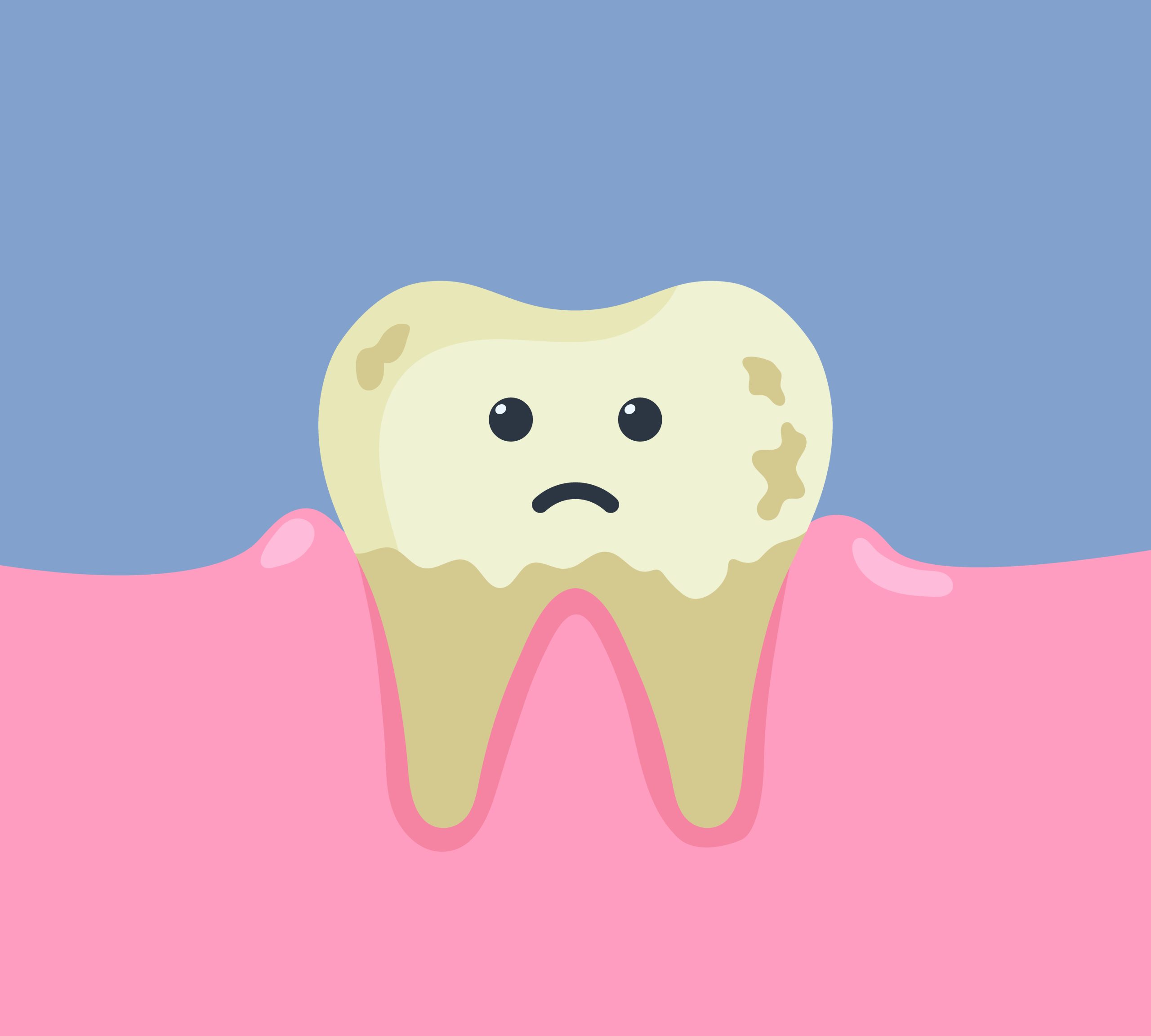 tooth whitening Tooth Discoloration A sad, dirty tooth with stains and cavities sits in pink gums on a blue background.